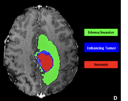 MRI slice with BraTS tumor class colors overlaid.