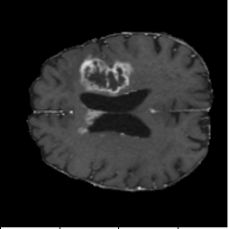 FNO input MRI slice.