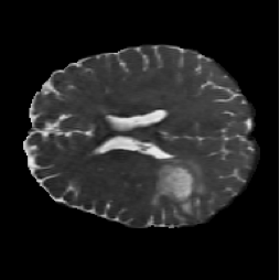 FNO-Diffusion input MRI slice.